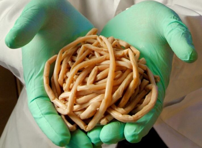 Longo verme parasitario en mans dun médico